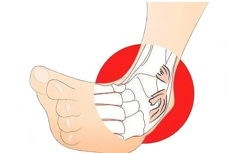 踝關(guān)節(jié)扭傷