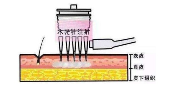 自己打水光針會導(dǎo)致面癱嗎